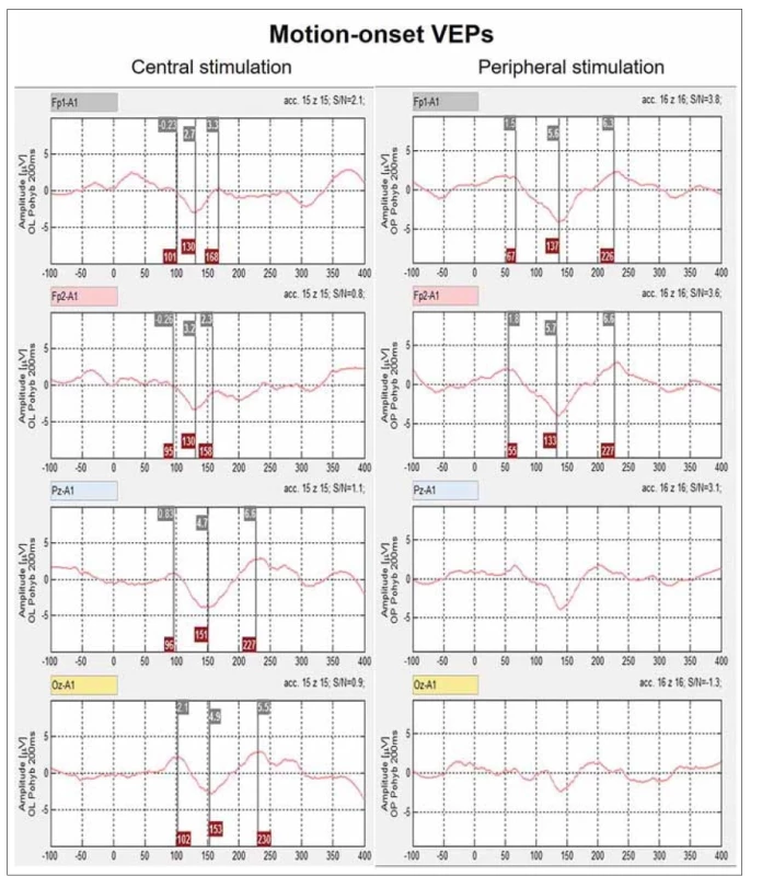 Ukázka motion-onset VEP při centrální stimulaci s dominantní reakcí v okcipito-perietální oblasti a při pariferní stimulaci s dominantní
reakcí v obou prefrontálních svodech.<br>
VEP – zrakové evokované potenciály<br>
Fig. 3. An example of motion-onset VEP by the central stimulation with the dominant reaction in the occipito-parietal area and by the
peripheral stimulation with the dominant reaction in both pre-frontal areas.<br>
VEP – visual evoked potentials