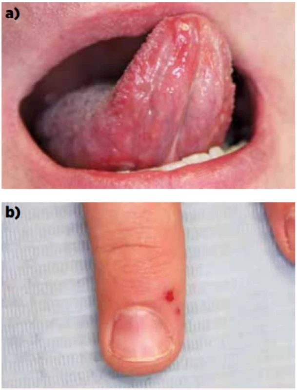 Hand-foot-and-mouth disease: a – postižení sliznice
dutiny ústní, b – postižení kůže