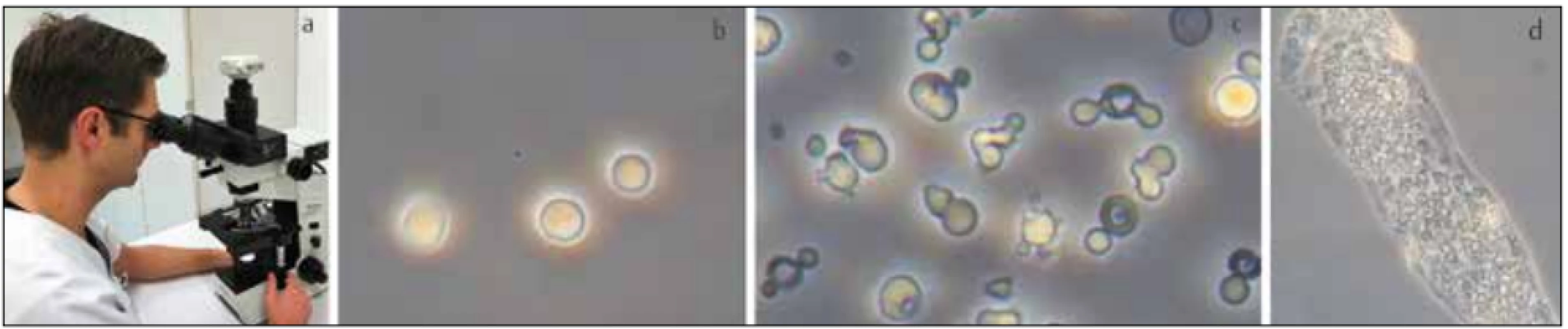 – A – mikroskopické vyšetření moči, B – normální erytrocyty svědčící pro neglomerulární příčinu hematurie,8
 C – akantocyty (erytrocyty s trnovitými výběžky
membrány) svědčící pro hematurii glomerulární etiologie, D – erytrocytární válce jsou patognomické pro glomerulonefritidy
