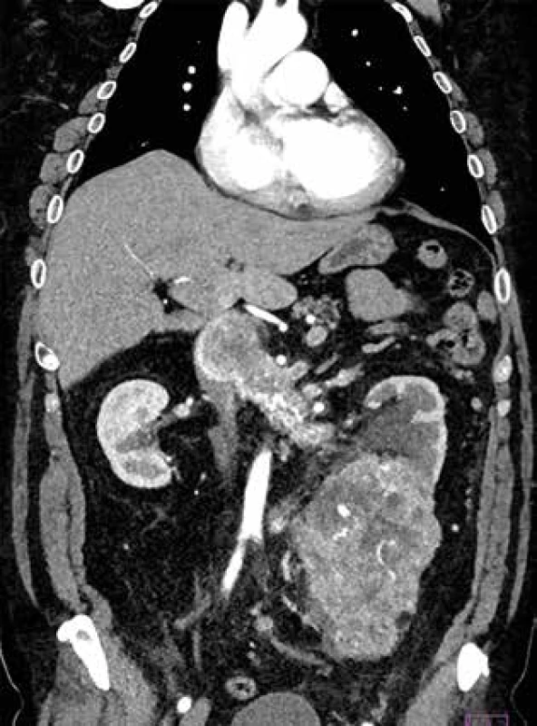 CT angiografický obraz nádorového trombu dolnej dutej žily pri karcinóme obličky <br>Fig. 1: CT angiography image of the tumour thrombus in the inferior vena cava in renal cell carcinoma