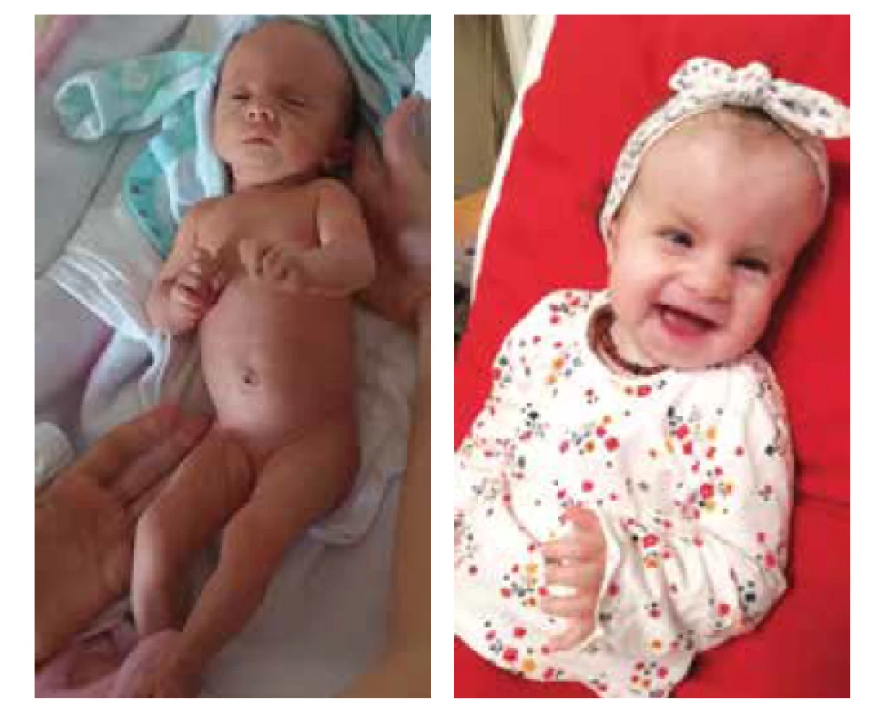 Edwardsův syndrom, postnatální fenotyp:<br>
a) po porodu,<br>
b) věk 18 měsíců.<br>
Fig. 2. Edwards syndrome, postnatal phenotype:<br>
a) after delivery,<br>
b) age 18 months.