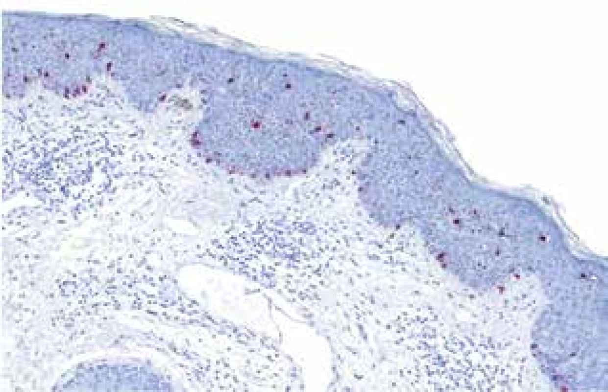 Imunohistochemické vyšetření melanocytárním markerem
tyrozinázou, která červeně značí kolonizaci dysplastického
epitelu dendritickými melanocyty