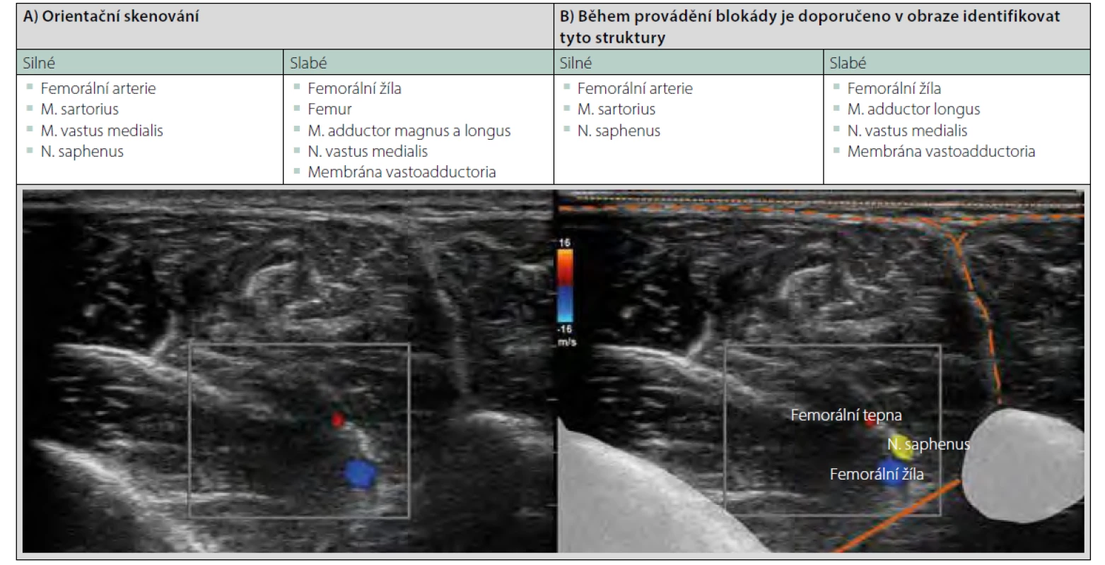 Adductor canal block