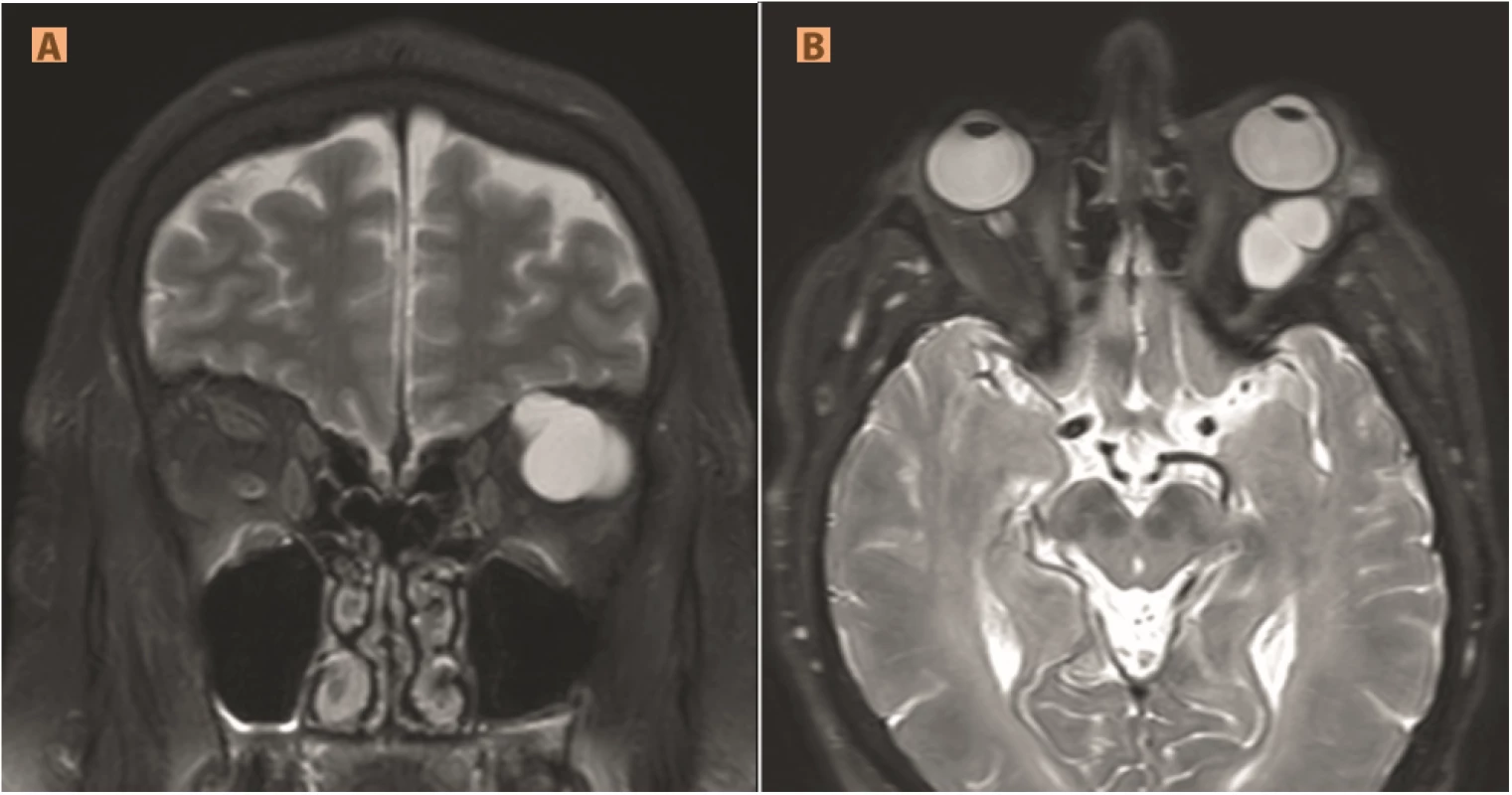 Lymphangioma: (A) bordered multilocular intraconal formation in left orbit hypersignal in T2WI and (B) T2STIR

