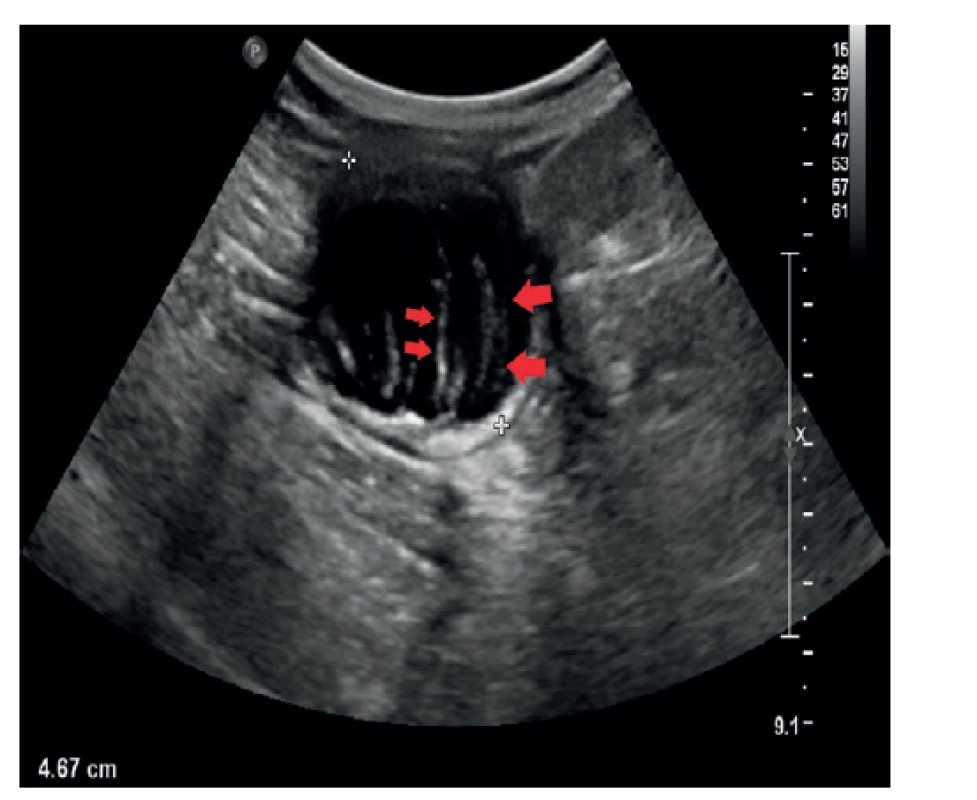 UZ obraz mukokély apendixu – transverzálně<br>
Sonografie břicha. V oblasti céka tubulární, převážně anechogenní
útvar, který je částečně vyplněn echogenním obsahem
(červené šipky). Klinika radiologie a nukleární medicíny FN
Brno a LF MU.<br>
Fig. 1: Ultrasound image of appendiceal mucocele – transverse
projection<br>
Sonography of the abdomen. A tubular, mostly anechogenic
formation is present in the area of the cecum, which is partially
filled with echogenic content (red arrows). Department
of Radiology and Nuclear Medicine, University Hospital Brno,
Faculty of Medicine, Masaryk University.