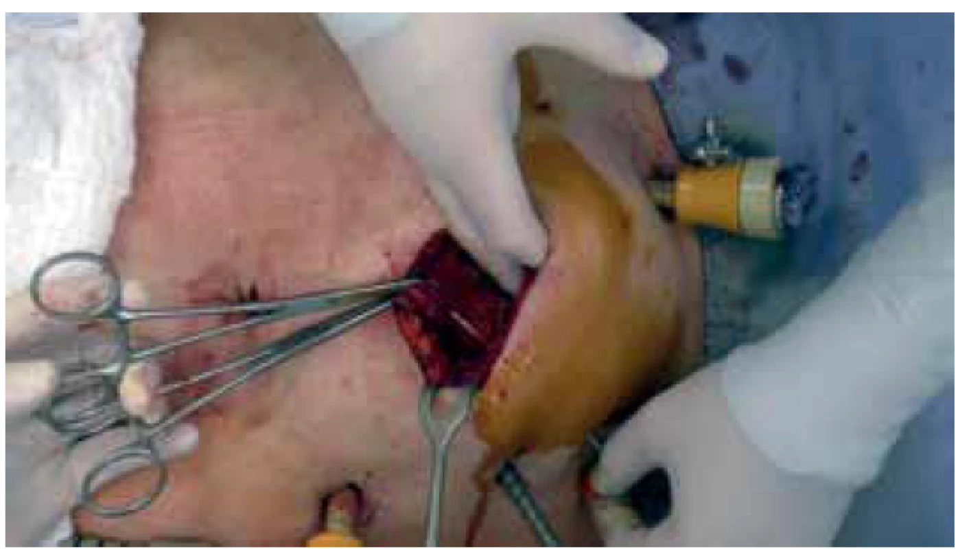 Zavaděč katétru v laparotomii<br>
Fig. 1. Catheter introducer in laparotomy