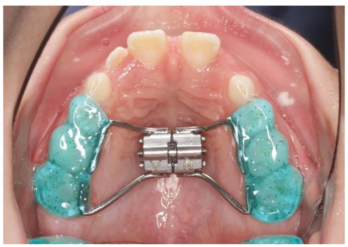 Pryskyřičný aparát se
šroubem (zdroj: archiv
ortodontického oddělení FN
Motol)<br>
Fig. 1 Resin apparatus with a screw
(source: archive of the
orthodontic department of the
Motol University Hospital)