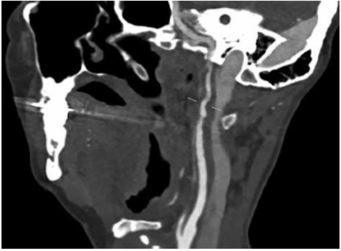 Akutní trombóza ACI sin. na CTAg v bočné projekci  <br>
Fig. 2. Acute thrombosis ACI sin. on CTAg in lateral projection
