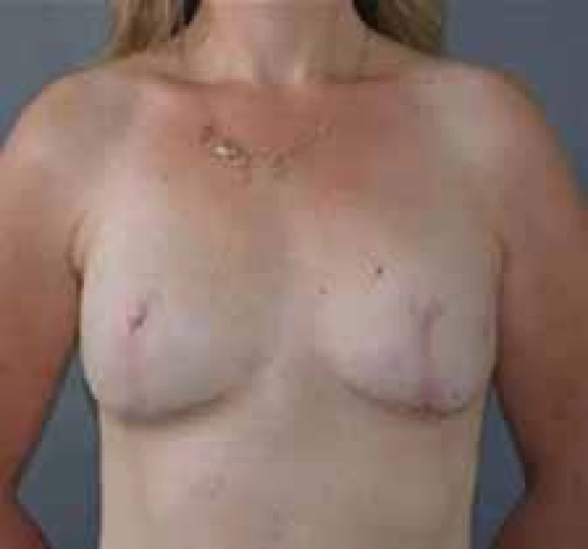 Okamžitá rekonstrukce prsou u pacientky s BRCA2 mutací. Provedena kůži šetřící (skin sparing) mastektomie
s pexí a rekonstrukcí pomocí silikonových implantátů s vytvořením bradavek.<br>
Fig. 1. Immediate breast reconstruction in a patient with BRCA2 mutation. Skin sparring mastectomy with pex and reconstruction
using silicone implants for the formation of nipples.