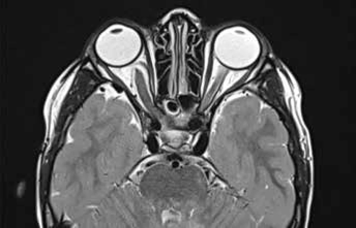 MR T2 TSE sectional trans. scan of optic glioma
with slight protrusion of right eyeball. Source: Children’s
Radiology Clinic, Faculty of Medicine, Masaryk University
and University Hospital Brno
