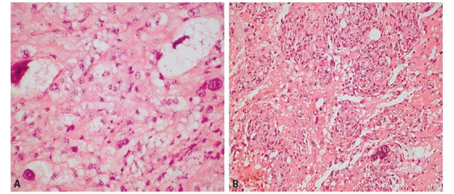 A: Nádor obsahoval zóny s monštróznymi lipoblastami (hematoxylin-eozín, 400x).<br>
B: Druhú zložku nádoru predstavovala vretenobunková populácia objemnejších pleiomorfných buniek so svetlou cytoplazmou, ojedinele<br>
s bizarným jadrom, s naznačenou multinodulárnou architektonikou (hematoxylin-eozín, 200x).