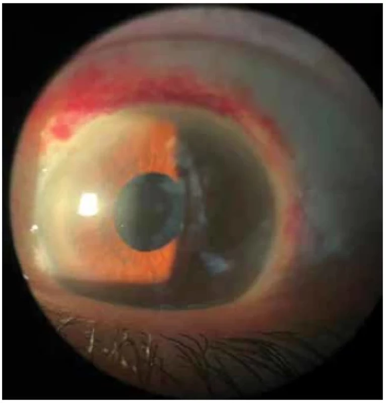 Post-operative view of the corneal surface after excisional
biopsy