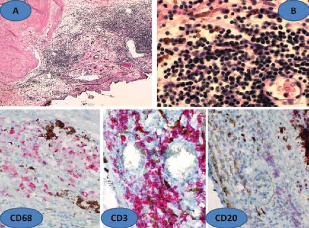 Histological finding of sympathetic ophthalmia (SO) – hypertrophied uvea with infiltrate
of lymphocytes and macrophages (A), enlargement 100x, HE, detail of lymphocytic
infiltrate of choroid (B), enlargement 600x, HE. Below immunohistochemical verification of
SO. Dalen-Fuchs nodule bordered CD68, further CD3 and CD20, enlargement 400x