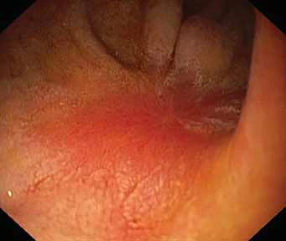 Healing duodenal ulcer after prednison treatment.<br>
Obr. 5. Kontrolní EGFS na terapii kortikoidy – hojení duodenálního vředu.