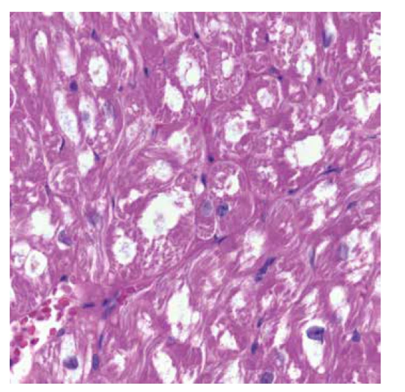 Endomyokardiální biopsie. Detail předchozího snímku s nápadnou
vakuolizací cytoplasmy hypertrofických kardiomyocytů (HE, objektiv 40x).