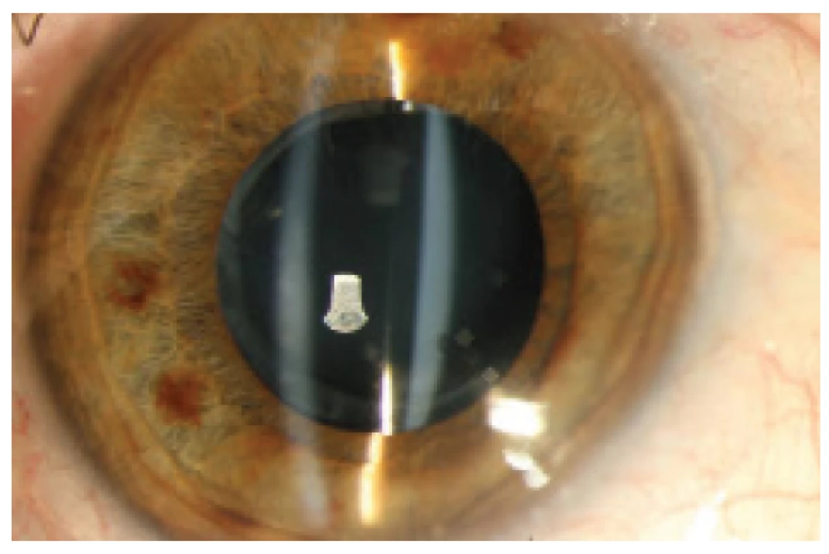 Anterior segment without signs of inflammation,
distended space between the posterior surface of IOL
and posterior capsule filled with milky white turbid fluid.
Fibrotically altered anterior capsule closely adhering to
the anterior surface of IOL.