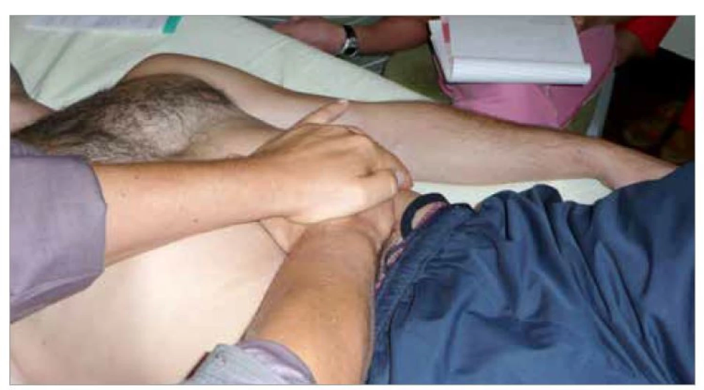 Ošetření omenta minus (zdroj: autor).<br>
Fig. 2. Treatment of the lesser omentum (source: author).