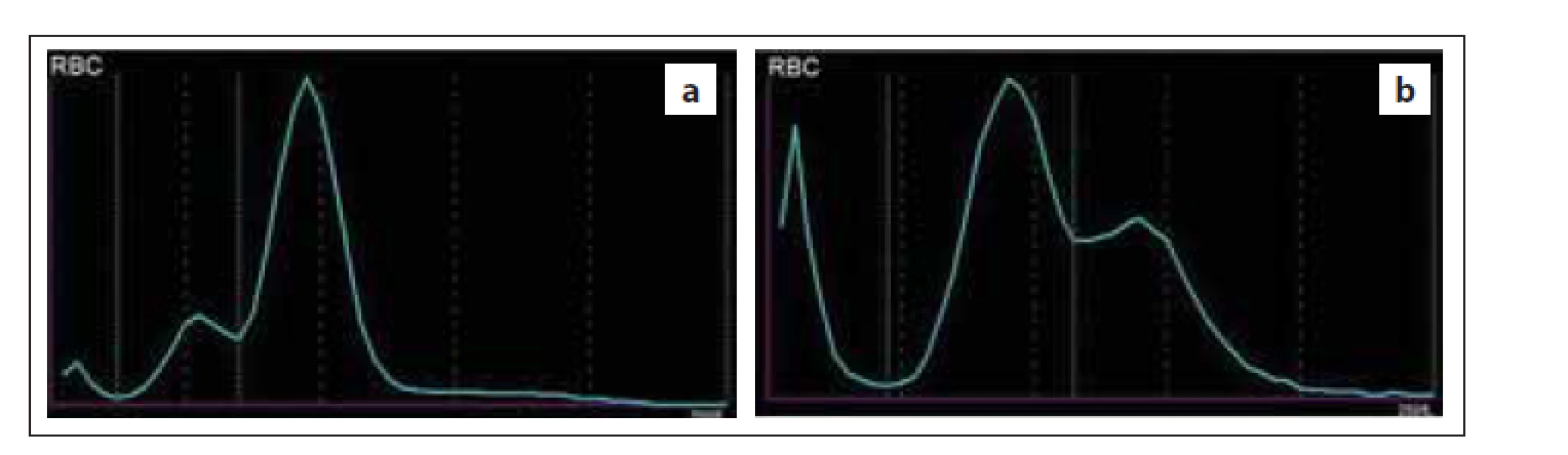 Histogram RBC s dimorfní populací erytrocytů – (a) nemocný po léčbě
defi citu železa; populace mikrocytů a normocytů, (b) nemocná s akutní
myeloidní leukemií; populace normocytů a makrocytů (zdroj: laboratoř IV. IHK).<br>
RBC – erytrocyty