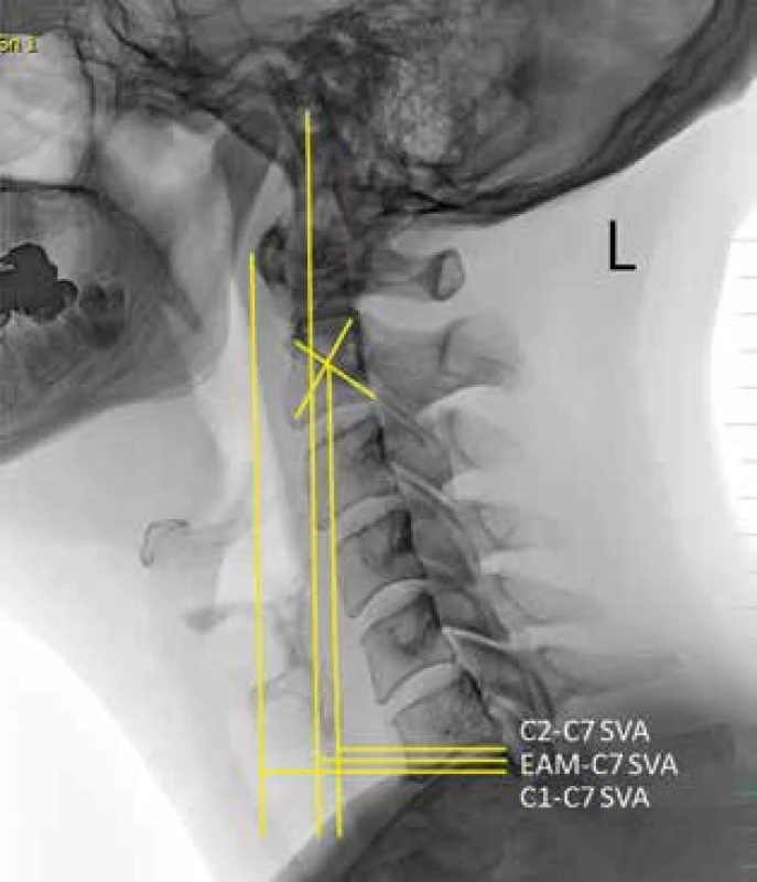 Parametry sagitální vertikální osy
EAM external auditory meatus<br>
Fig. 2: Parameters of the sagittal vertical axis
EAM external auditory meatus