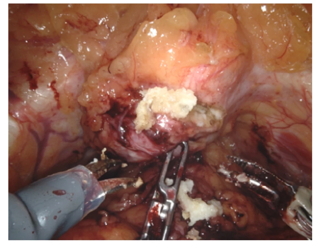 Po naříznutí perichondria se vyprazdňují hmoty
připomínající revmatické tofy<br>
Fig. 4. Following incision of perichondrium, mass
protruded and resembling rheumatic toff