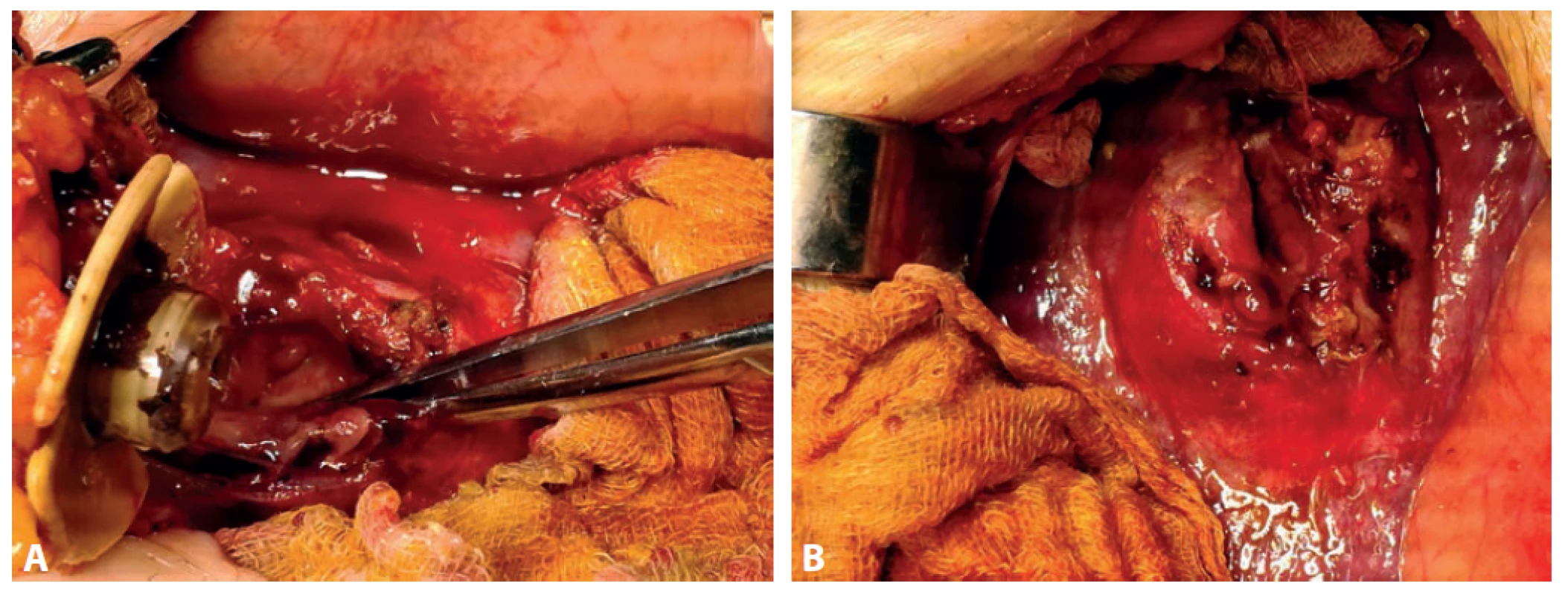 Peroperačný nález dislokovaného PEG do S2 heparu (a) s abscesovou dutinou (b)<br>
Fig. 2. Peroperative fi nding of dislocated PEG to S2 of the liver (a) with abscess cavity (b)
