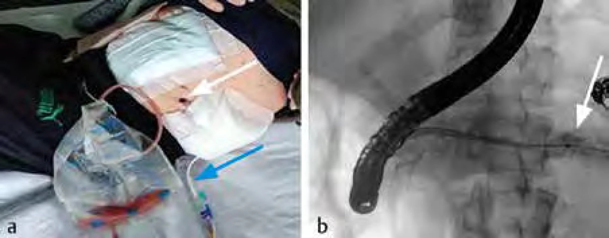 a) Po provedení VARD (videoasistovaný retroperitoneální débridement) vznikla jako komplikace píštěl
ocasu pankreatu (bílá šipka ukazuje na kanál VARD), modrá šipka ukazuje na odlehčovací drenáž píštěle ocasu
pankreatu); b) zobrazení píštěle ocasu pankreatu pomocí endoskopické retrográdní cholangiopankreatikografie
(ERCP) (bílá šipka ukazuje na únik kontrastní látky v okolí ocasu pankreatu)