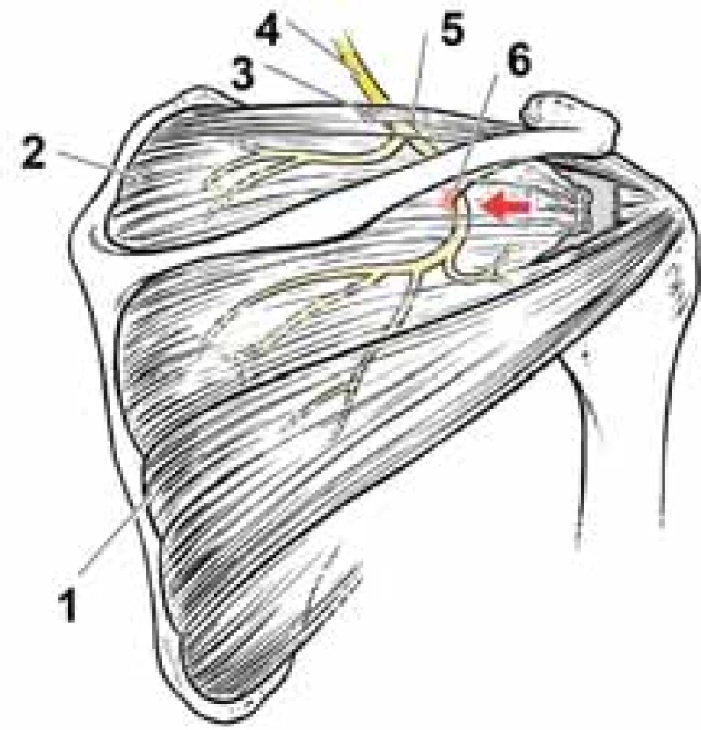  Anatomie n. suprascapularis
a schéma útlaku větve pro m. infraspinatus o hranu spinoglenoidální brázdy po
retrakci mm. spinati při ruptuře rotátorové
manžety (šipka). Převzato z [9], upraveno.<br>
Fig. 1. Suprascapular nerve anatomy and
the scheme of infraspinatus branch compression against the edge of the spinoglenoid notch after retraction of spinati muscles during rotator cuff rupture
(arrow). From [9], modified.