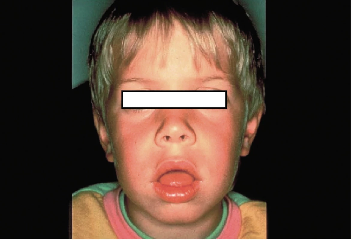 Facies adenoidea.