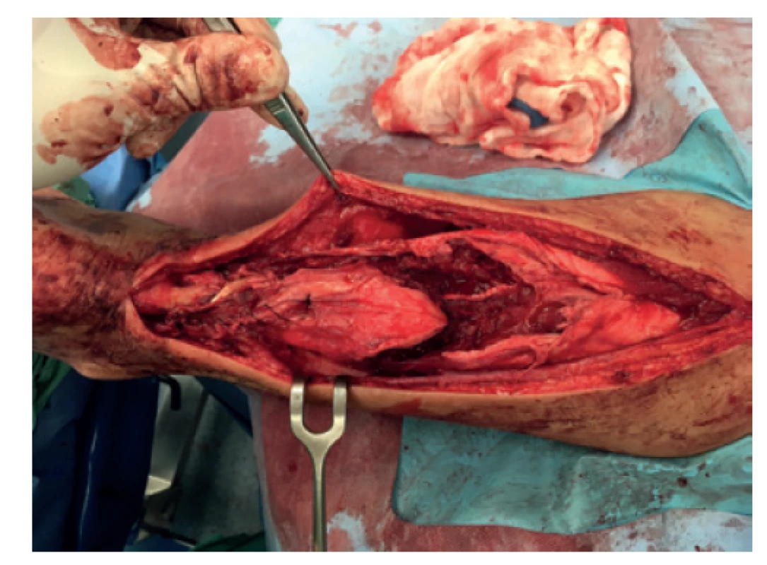 Plastika Achillovy šlachy podle Abrahama-Pankowiche
pomocí V-Y skluzu<br>
Perioperační foto po V řezu a sesunutí pahýlu distálně.<br>
Fig. 3: Abraham-Pankowich technique of Achilles tendon
plasty using V-Y transfer<br>
Perioperative picture documenting the V incision and distal
translation of the tendon.