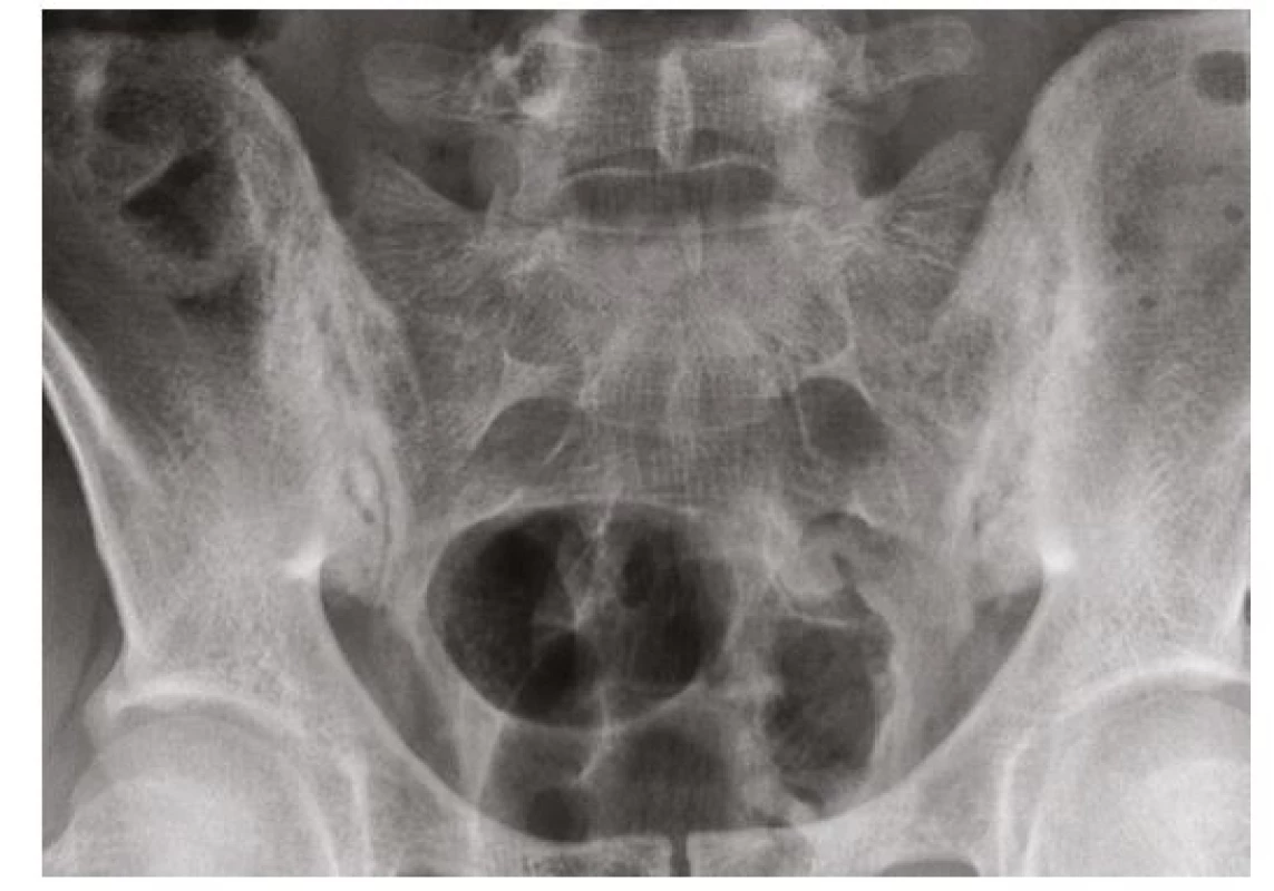 Radiogram SI skloubení s nálezem sakroilitidy pestrého obrazu
s kombinací erozivních a osteoporuktivních změn