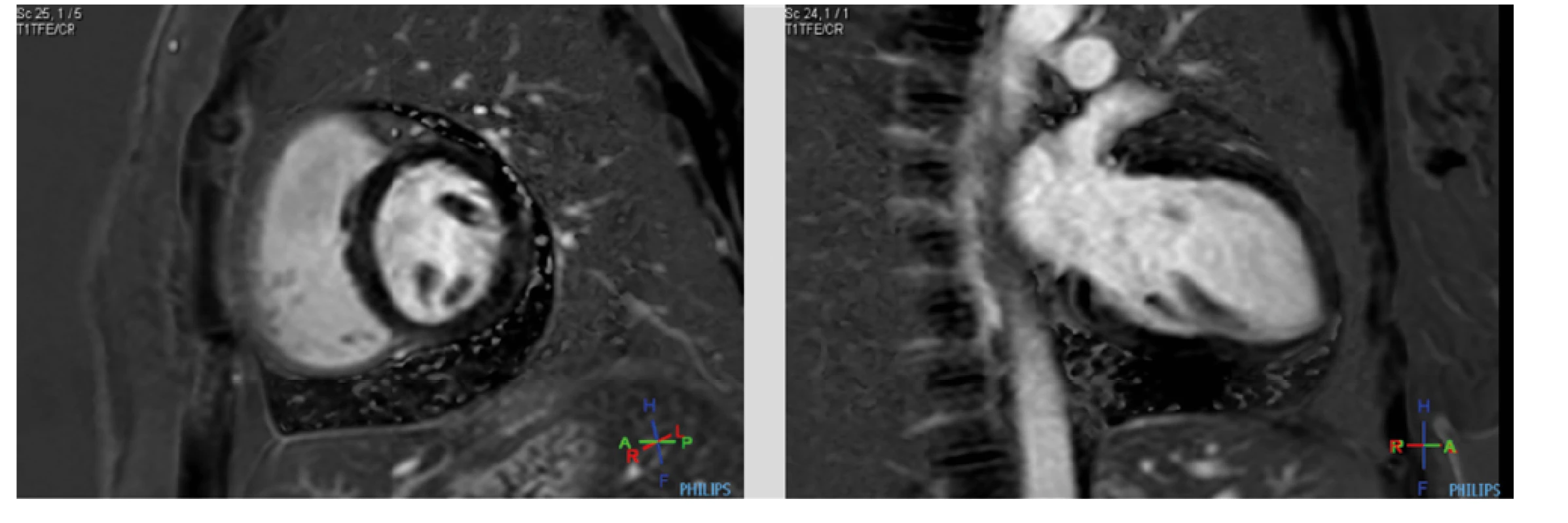 (a, b). MRI srdce. Pozdní postkontrastní sekvence ve vertikální dlouhé ose (dvoudutinová projekce) a krátké ose: perikardiální listy bez průkazu
pozdního sycení gadoliniovou kontrastní látkou
