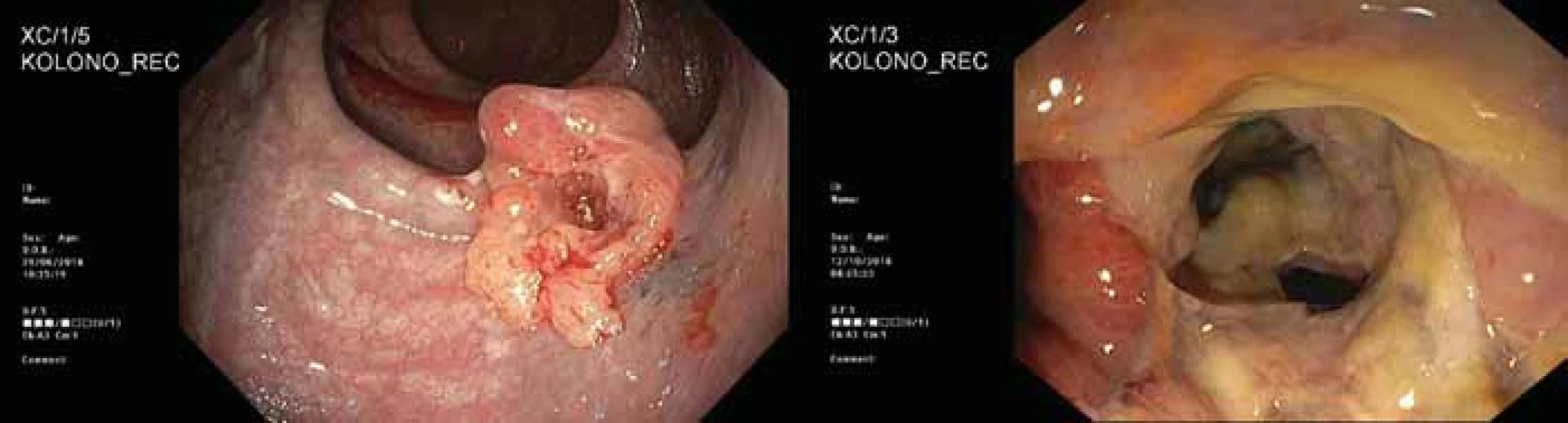  Endoskopický obraz nádoru zadní stěny konečníku před léčbou (vlevo) a endoskopický obraz rektovaginální píštěle na
přední stěně konečníku po operaci (vpravo).