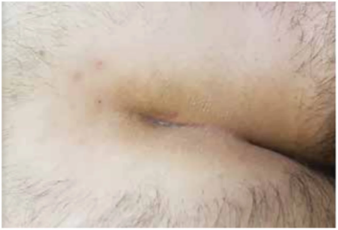 Pooperační jizva − E.P.Si.T. (archiv autorů)<br>
Fig. 2: Postoperativescar − E.P.Si.T. (authors´ archive)