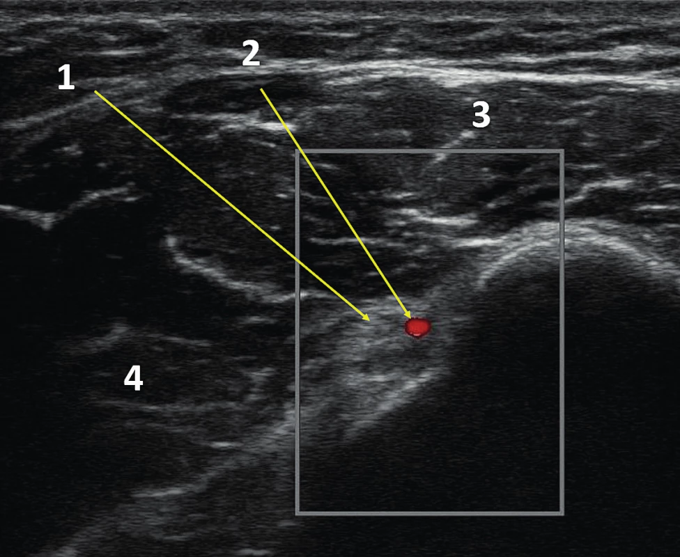 UZ obraz boční strany proximální paže (colour
doppler)<br>
1 – n. axillaris, 2 – a. axillaris, 3 – m. deltoides, 4 – m. teres minor