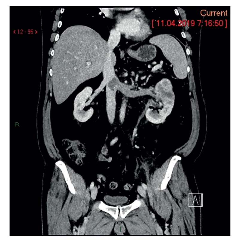 Ľavá oblička s nádorom a v. renalis s nádorovým
trombom zasahujúcim do VCI<br>
Fig. 8: Left kidney with tumor and v. renalis with a tumor
thrombus extending into VCI