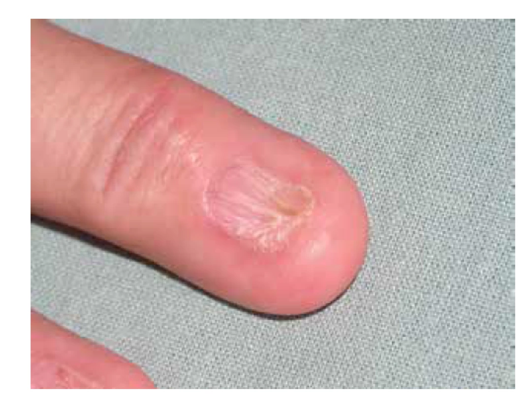 Pterygium unguiium (dorsalis): přerůstání proximálního
nehtového valu a jeho srůstu s nehtovým lůžkem