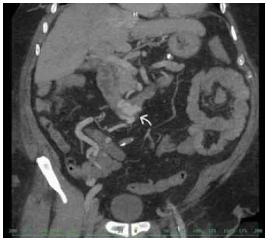 CT zobrazení duodenálních varixů umístěných v D􀍹,
označené šipkou. <br> 
Fig. 2. CT image of duodenal varices located in D􀍹, marked with
an arrow.