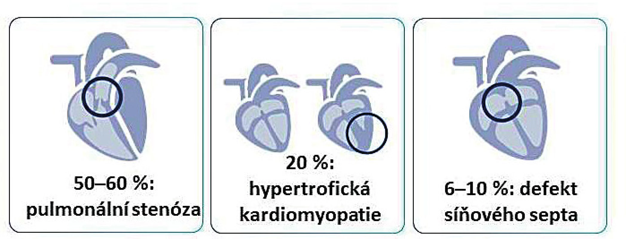 Kardiální fenotyp u dětí s RASopatiemi/syndromem
Noonanové.