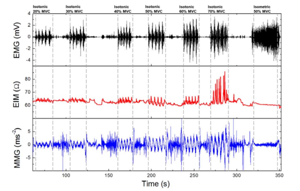 Total Holter EMG/EIM/MMG=f(t) signal of one volunteer (male, age 38, BMI 22.4). 6 series of 5 lifting’s
followed by isometric exercise.