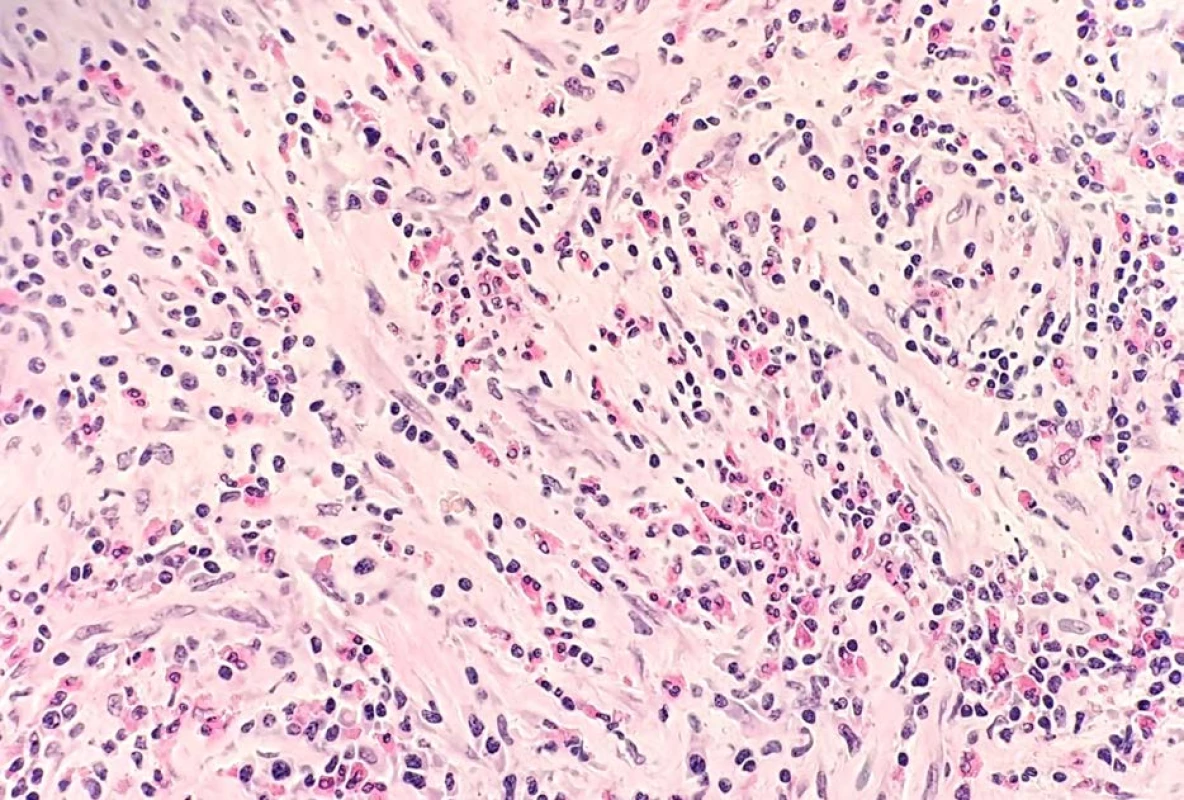 Detail eosionofilní funkilutidy (hematoxyilin-eosin, 200x)<br>
Fig. 3. Detail of eosinophilic funiculitis (hemathoxylin-eosin, 200x)