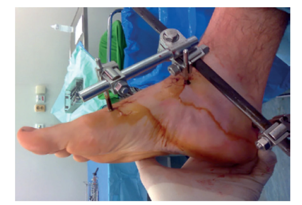 Naložený zevní fixátor na tříštivou zlomeninu kalkanea<br>
Schanzovy šrouby zavedeny do 1. metatarsu, krčku talu a tuberu
patní kosti.<br>
Fig. 3: External fixator placed on a comminuted calcaneal
fracture<br>
Pins are inserted into the 1st metatarsal, talar neck and calcaneal
tuberosity.