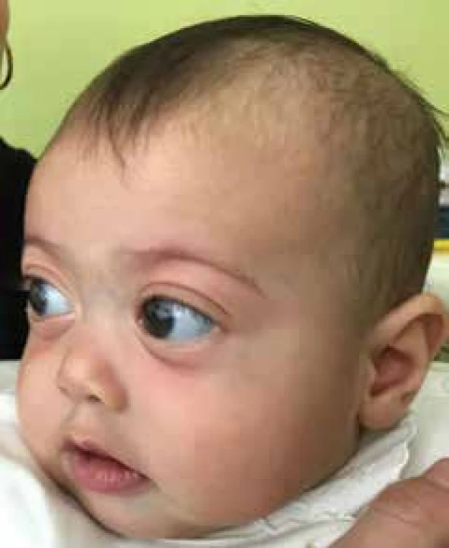 Central
facial dysmorphia,
shallow
orbits, pseudoexophthalmos,
hypertelorism
and low root of
nose in patient
with Marshall/
Stickler syndrome
at age of 4
months.