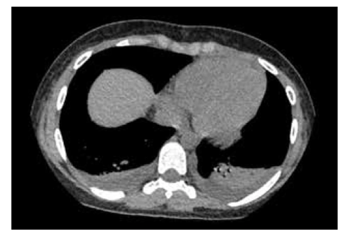 HRCT (high-resolution computed tomography) vyšetrenie
pľúc pacientky z klinického prípadu 2 – bazálne prítomný
drobný fluidothorax s priľahlými malými atelektázami
pľúc bilaterálne, bez nálezu ground glass opacification typických
pre bronchopneumóniu asociovanú s COVID-19.<br>
Fig. 5. HRCT examination of patient’s lungs from case report 2
– pleural effusions with adjancent small lung atelectases bilaterally,
without finding ground glass opacification typical of
COVID-19 bronchopneumonia.