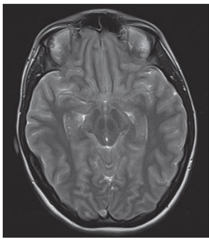 Obr. 2. MR mozku, T1 vážený obraz
sagitální. Prominence kaudálních částí
mozečku intraspinálně, zúžení IV. komory.<br>
Fig. 2. MRI of the brain, T1-weighted
image, sagittal plane. Caudal displacement
of cerebellar tonsils, narrowing of the fourth
ventricle.