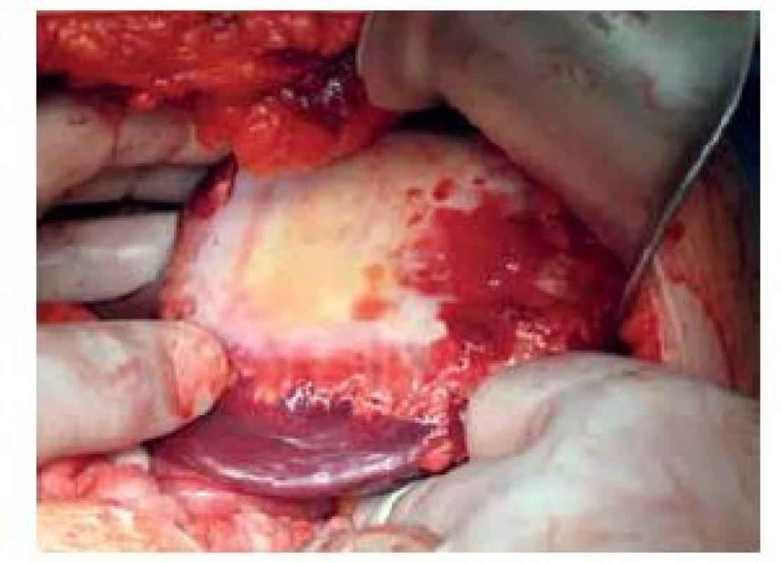 Findings during surgical intervention – cyst in the
left liver lobe