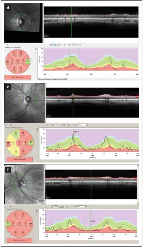 Tloušťka vrstev RNFL v peripapilární
oblasti měřená optickou koherenční tomografií.
Hodnoty mezi 5. a 95. percentilem
normy jsou kódovány zeleně, mezi 1. a 5. percentilem
normy žlutě a pod 1. percentilem
normy červeně.<br>
(d–f) zobrazují nálezy po proběhlém zánětu
zrakového nervu u neuromyelitis optica a onemocnění
jejího širšího spektra. V těchto očích je
zjevný výrazný pokles tloušťky RNFL ve všech
peripapilárních segmentech (červeně a žlutě).<br>
Fig. 1. Peripapillary thickness of RNFL as measured
by optical coherence tomography. Results
of RNFL thickness are color coded with
values between 5th and 95th percentile of normal
coded in green, values between 1st and
5th percentile yellow and values below 1st percentile
red.
(d–f) show a loss of RNFL in all peripapillary
segments (yellow and red) in patients post
optic neuritis in neuromyelitis optica spectrum
disorders.