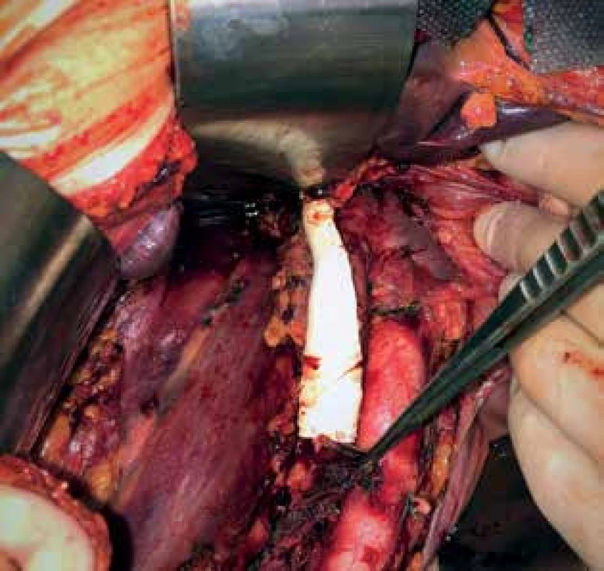 Parciální resekce DDŽ pro infiltraci nádorovým 
trombem, náhrada ePTFE protézou<br>
Fig. 1: Partial VCI resection due to malignant thrombus 
infiltration, ePTFE graft replacement