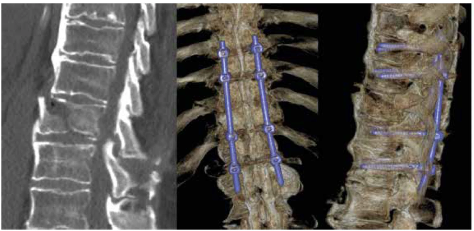 Zlomenina Th10 u pacienta s DISH (M2) mechanismem hyperextenze s poranění předního závěsného
aparátu (B3) bez neurologické léze (N0) TL AOSIS – 7, řešena dlouhou transpedikulární instrumentací
ze zadního přístupu<br>
Fig. 2. Fracture of Th10 in DISH patient (M2) with anterior tension band injury from hyperextension (B3),
without neurological deficit (N0) TL AOSIS – 7, treated by posterior transpedicular long instrumentation