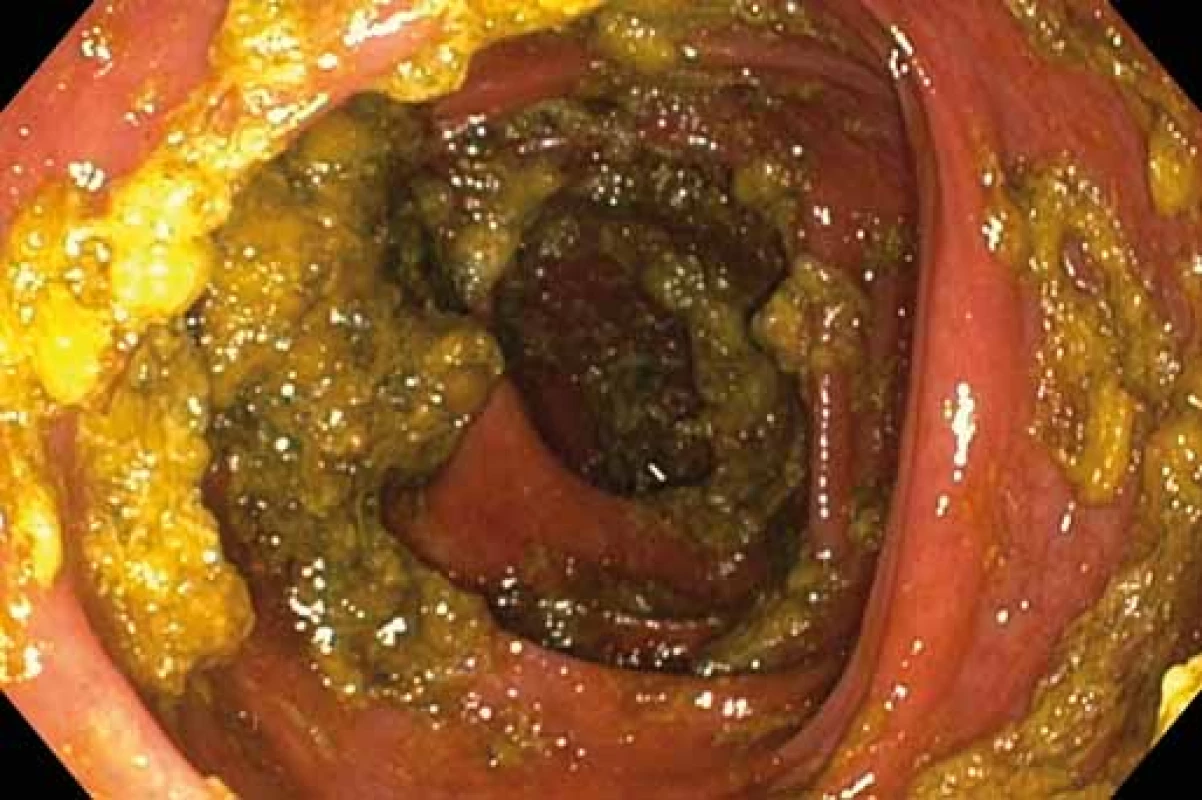 Stupeň střevní přípravy C. Zdroj: Archiv oddělení
gastrointestinální endoskopie, ÚVN VFN, Praha.<br>
Fig. 3. Degree of intestinal preparation C. Source: Archive
department of gastrointestinal endoscopy, ÚVN Military
university hospital, Prague.