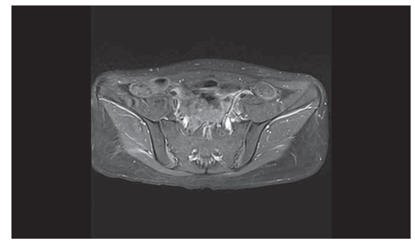 Vyšetření pánve magnetickou rezonancí (T1 sekvence) zobrazuje cystu
pravého ovaria.<br>
Fig. 1. Examination of the pelvis by magnetic resonance (T1 sequence) showing a
cyst of the right ovary.